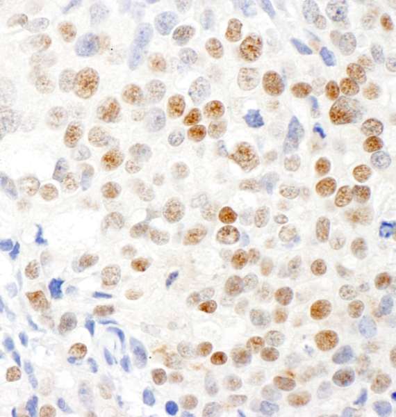 Detection of Human Virilizer by Immunohistochemistry. Sample: FFPE section of human breast carcinoma. Antibody: Affinity purified rabbit anti-Virilizer used at a dilution of 1:1000 (1 ug/ml). Detection: DAB.