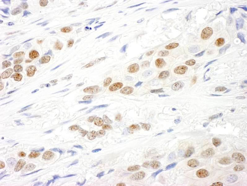 Detection of Human Virilizer by Immunohistochemistry. Sample: FFPE section of human breast carcinoma. Antibody: Affinity purified rabbit anti-Virilizer used at a dilution of 1:250.