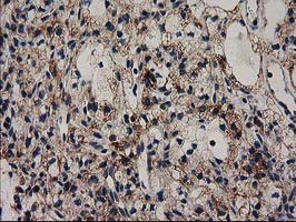 IHC of paraffin-embedded Carcinoma of Human kidney tissue using anti-GRHPR mouse monoclonal antibody. (Heat-induced epitope retrieval by 10mM citric buffer, pH6.0, 100C for 10min).