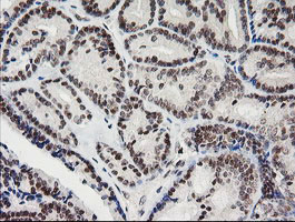 IHC of paraffin-embedded Carcinoma of Human thyroid tissue using anti-KIF25 mouse monoclonal antibody.
