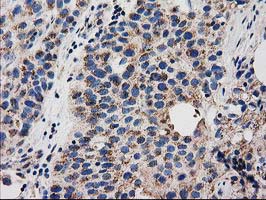 IHC of paraffin-embedded Carcinoma of Human bladder tissue using anti-GRHPR mouse monoclonal antibody. (Heat-induced epitope retrieval by 10mM citric buffer, pH6.0, 100C for 10min).