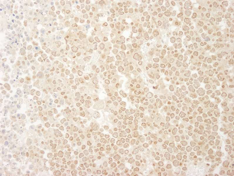 Detection of Mouse MCAK by Immunohistochemistry. Sample: FFPE section of mouse hybridoma tumor. Antibody: Affinity purified rabbit anti-MCAK used at a dilution of 1:250. Epitope Retrieval Buffer-High pH (IHC-101J) was substituted for Epitope Retrieval Buffer-Reduced pH.
