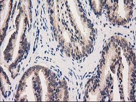 IHC of paraffin-embedded Carcinoma of Human prostate tissue using anti-GRHPR mouse monoclonal antibody. (Heat-induced epitope retrieval by 10mM citric buffer, pH6.0, 100C for 10min).