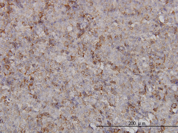 Immunoperoxidase of monoclonal antibody to KIF2C on formalin-fixed paraffin-embedded human malignant lymphoma, diffuse large B. [antibody concentration 3 ug/ml].