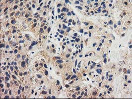 IHC of paraffin-embedded Carcinoma of Human bladder tissue using anti-GRHPR mouse monoclonal antibody. (Heat-induced epitope retrieval by 10mM citric buffer, pH6.0, 100C for 10min).
