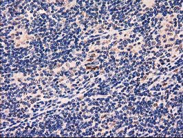 IHC of paraffin-embedded Human lymphoma tissue using anti-GRHPR mouse monoclonal antibody. (Heat-induced epitope retrieval by 10mM citric buffer, pH6.0, 100C for 10min).