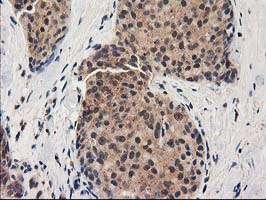 IHC of paraffin-embedded Adenocarcinoma of Human breast tissue using anti-GRHPR mouse monoclonal antibody. (Heat-induced epitope retrieval by 10mM citric buffer, pH6.0, 100C for 10min).