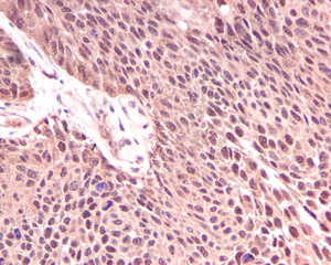 IHC of paraffin-embedded bladder carcinoma tissue using anti-KIFAP3 antibody. 