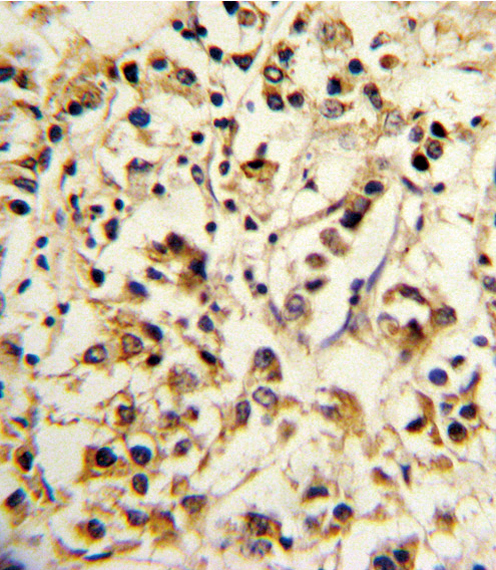 Formalin-fixed and paraffin-embedded human breast carcinoma reacted with KIR2DL4 Antibody , which was peroxidase-conjugated to the secondary antibody, followed by DAB staining. This data demonstrates the use of this antibody for immunohistochemistry; clinical relevance has not been evaluated.