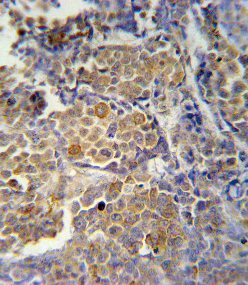 KIR2DS2 Antibody immunohistochemistry of formalin-fixed and paraffin-embedded human skin carcinoma followed by peroxidase-conjugated secondary antibody and DAB staining.