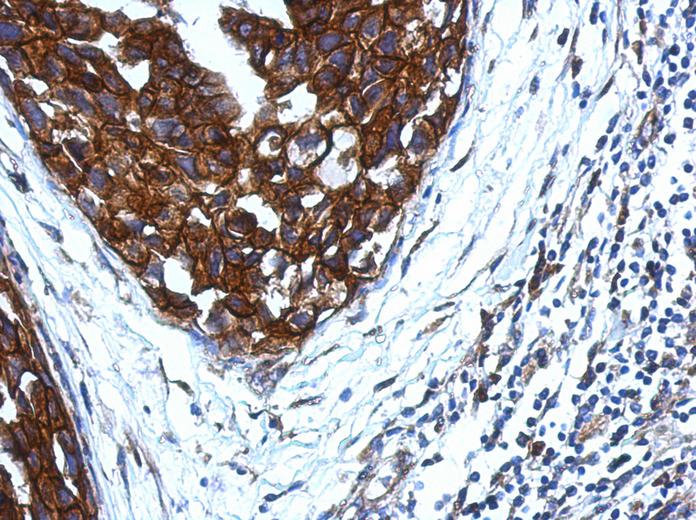 IHC of paraffin-embedded Breast ca, using KIR2DS4 antibody at 1:500 dilution.
