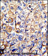 Formalin-fixed and paraffin-embedded human breast carcinoma with KIR2DS4 Antibody (Center), which was peroxidase-conjugated to the secondary antibody, followed by DAB staining.