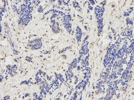 Immunohistochemistry of paraffin-embedded human breast cancer using KIR3DL1 antibody at dilution of 1:200 (200x lens).