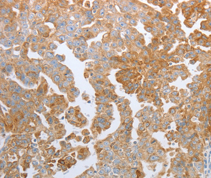 Immunohistochemistry of paraffin-embedded human ovarian cancer tissue using KISS1R antibody.