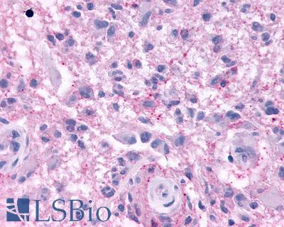Anti-KISS1R / GPR54 antibody IHC of human Brain, Glioblastoma. Immunohistochemistry of formalin-fixed, paraffin-embedded tissue after heat-induced antigen retrieval.