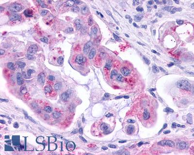 Anti-KISS1R / GPR54 antibody IHC of human Pancreas, Carcinoma. Immunohistochemistry of formalin-fixed, paraffin-embedded tissue after heat-induced antigen retrieval.