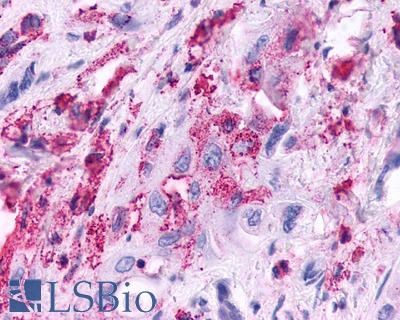 Anti-KISS1R / GPR54 antibody IHC of human Pancreas, Carcinoma. Immunohistochemistry of formalin-fixed, paraffin-embedded tissue after heat-induced antigen retrieval.