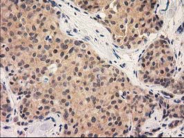 IHC of paraffin-embedded Adenocarcinoma of Human breast tissue using anti-GRHPR mouse monoclonal antibody.