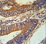 KLC3 Antibody immunohistochemistry of formalin-fixed and paraffin-embedded human colon carcinoma followed by peroxidase-conjugated secondary antibody and DAB staining.