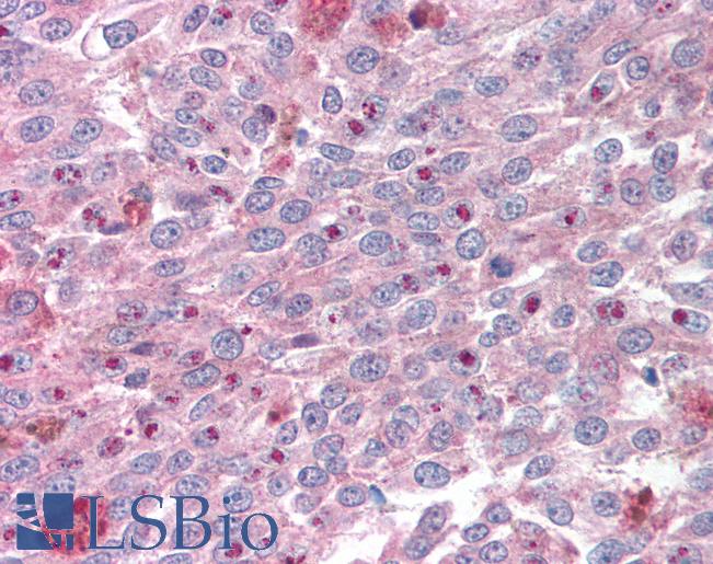 Anti-KLF4 antibody IHC of human melanoma. Immunohistochemistry of formalin-fixed, paraffin-embedded tissue after heat-induced antigen retrieval. Antibody LS-B1192 concentration 5 ug/ml.