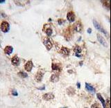 Formalin-fixed and paraffin-embedded human prostate carcinoma tissue reacted with KLF4 antibody (N-term C74) , which was peroxidase-conjugated to the secondary antibody, followed by DAB staining. This data demonstrates the use of this antibody for immunohistochemistry; clinical relevance has not been evaluated.