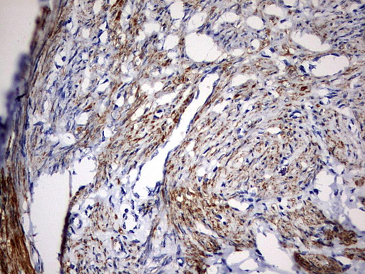 IHC of paraffin-embedded Adenocarcinoma of Human endometrium tissue using anti-KLHL12 mouse monoclonal antibody. (Heat-induced epitope retrieval by 10mM citric buffer, pH6.0, 120°C for 3min).