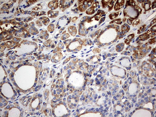 IHC of paraffin-embedded Carcinoma of Human thyroid tissue using anti-KLHL12 mouse monoclonal antibody. (Heat-induced epitope retrieval by 10mM citric buffer, pH6.0, 120°C for 3min).
