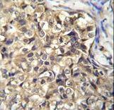 KLHL35 Antibody immunohistochemistry of formalin-fixed and paraffin-embedded human breast carcinoma followed by peroxidase-conjugated secondary antibody and DAB staining.
