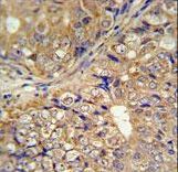 KLHL9 Antibody IHC of formalin-fixed and paraffin-embedded human prostate carcinoma followed by peroxidase-conjugated secondary antibody and DAB staining.