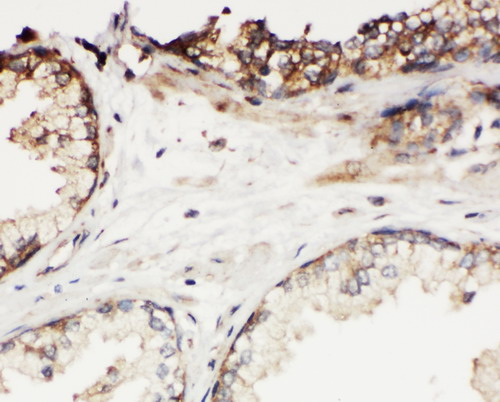 KLK11 / Kallikrein 11 antibody. IHC(P): Human Prostatic Cancer Tissue.