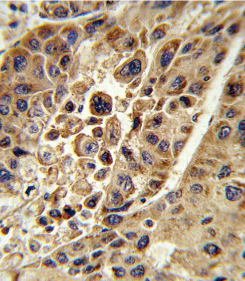 Formalin-fixed and paraffin-embedded human hepatocarcinoma reacted with KMO Antibody , which was peroxidase-conjugated to the secondary antibody, followed by DAB staining. This data demonstrates the use of this antibody for immunohistochemistry; clinical relevance has not been evaluated.