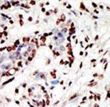 Formalin-fixed and paraffin-embedded human cancer tissue reacted with the primary antibody, which was peroxidase-conjugated to the secondary antibody, followed by AEC staining. This data demonstrates the use of this antibody for immunohistochemistry; clinical relevance has not been evaluated. BC = breast carcinoma; HC = hepatocarcinoma.
