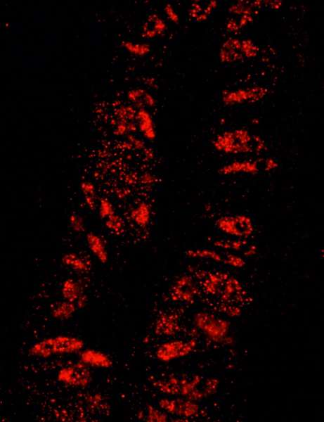 Detection of Human KPNA3 by IHC-IF. Sample: FFPE section of human colon carcinoma. Antibody: Affinity purified rabbit anti-KPNA3 used at a dilution of 1:100. Detection: Red-fluorescent goat anti-rabbit IgG highly cross-adsorbed Antibody used at a dilution of 1:100.