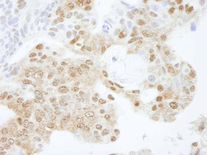 Detection of Human KPNA3 by Immunohistochemistry. Sample: FFPE section of human ovarian carcinoma. Antibody: Affinity purified rabbit anti-KPNA3 used at a dilution of 1:250.