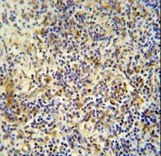 KRI1 antibody immunohistochemistry of formalin-fixed and paraffin-embedded human lung carcinoma followed by peroxidase-conjugated secondary antibody and DAB staining.