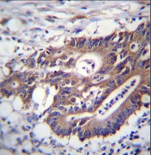 KRT12 Antibody immunohistochemistry of formalin-fixed and paraffin-embedded human colon carcinoma followed by peroxidase-conjugated secondary antibody and DAB staining.
