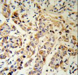 KRT13 Antibody (RB18903) IHC of formalin-fixed and paraffin-embedded human breast carcinoma followed by peroxidase-conjugated secondary antibody and DAB staining.