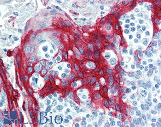 Anti-KRT16 / Cytokeratin 16 antibody IHC of human tonsil. Immunohistochemistry of formalin-fixed, paraffin-embedded tissue after heat-induced antigen retrieval. Antibody LS-B3917 dilution 1:25.