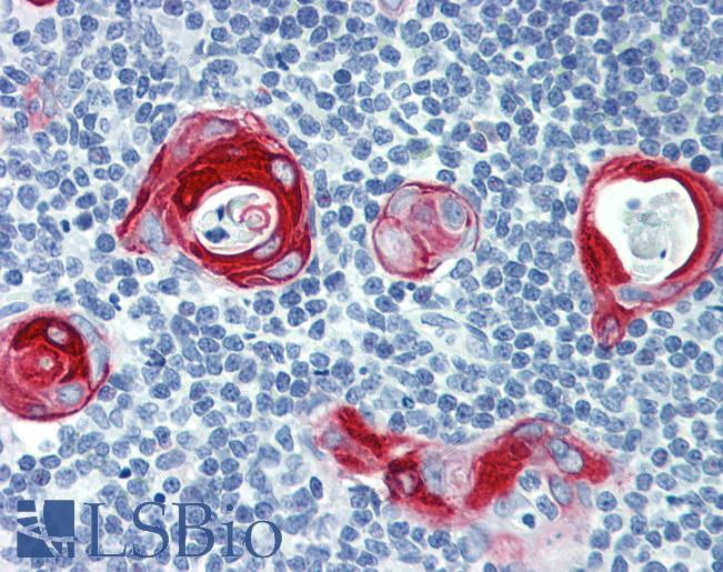 Anti-KRT16 / Cytokeratin 16 antibody IHC of human thymus. Immunohistochemistry of formalin-fixed, paraffin-embedded tissue after heat-induced antigen retrieval. Antibody LS-B3917 dilution 1:25.
