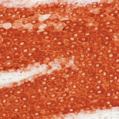 Formalin-fixed, paraffin-embedded human squamous carcinoma of lung stained with peroxidase-conjugate and AEC chromogen. Note cytoplasmic staining of tumor cells.