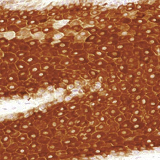 Formalin-fixed, paraffin-embedded human squamous carcinoma of lung stained with Cytokeratin 16 antibody LS-C95477.