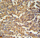 KRT19 Antibody IHC of formalin-fixed and paraffin-embedded human Lung carcinoma followed by peroxidase-conjugated secondary antibody and DAB staining.