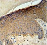 KRT35 Antibody IHC of formalin-fixed and paraffin-embedded skin carcinoma followed by peroxidase-conjugated secondary antibody and DAB staining.