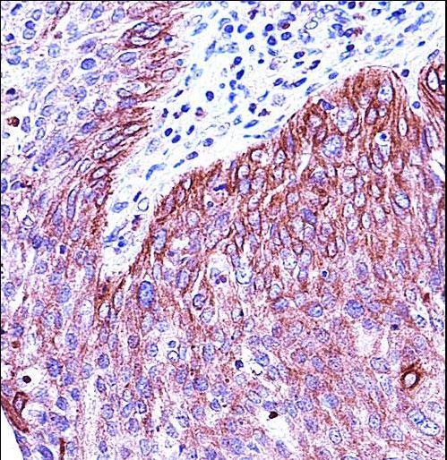 KRT6B Antibody immunohistochemistry of formalin-fixed and paraffin-embedded human cervical carcinoma followed by peroxidase-conjugated secondary antibody and DAB staining.