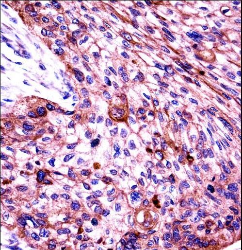 KRT6C Antibody immunohistochemistry of formalin-fixed and paraffin-embedded human esophagus carcinoma followed by peroxidase-conjugated secondary antibody and DAB staining.
