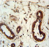 KRT82 Antibody immunohistochemistry of formalin-fixed and paraffin-embedded human skin carcinoma followed by peroxidase-conjugated secondary antibody and DAB staining.