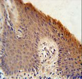 KRTAP1-1 Antibody immunohistochemistry of formalin-fixed and paraffin-embedded human skin carcinoma followed by peroxidase-conjugated secondary antibody and DAB staining.