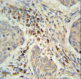 C19orf50 Antibody immunohistochemistry of formalin-fixed and paraffin-embedded human lung carcinoma followed by peroxidase-conjugated secondary antibody and DAB staining.