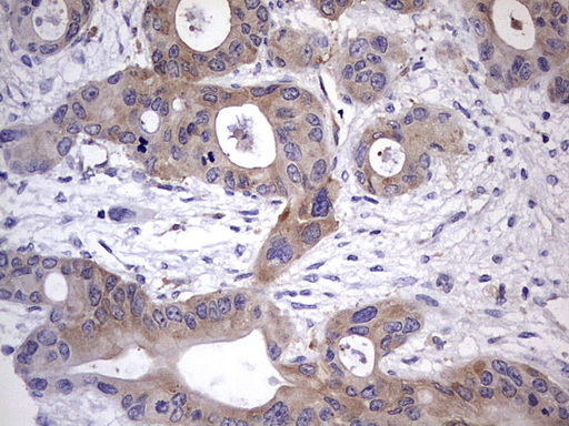 IHC of paraffin-embedded Carcinoma of Human pancreas tissue using anti-KYNU mouse monoclonal antibody. (heat-induced epitope retrieval by 1 mM EDTA in 10mM Tris, pH8.5, 120°C for 3min).