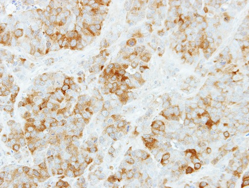 IHC of paraffin-embedded MCF7 xenograft using KYNU antibody at 1:500 dilution.
